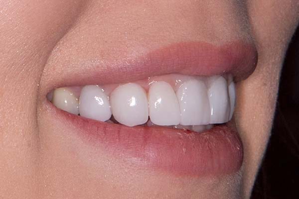 Full Mouth Veneers Cost in the Dominican Republic – What to Expect