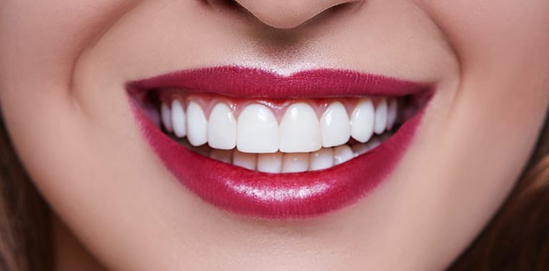 Porcelain Veneers in the Dominican Republic Prices & Options