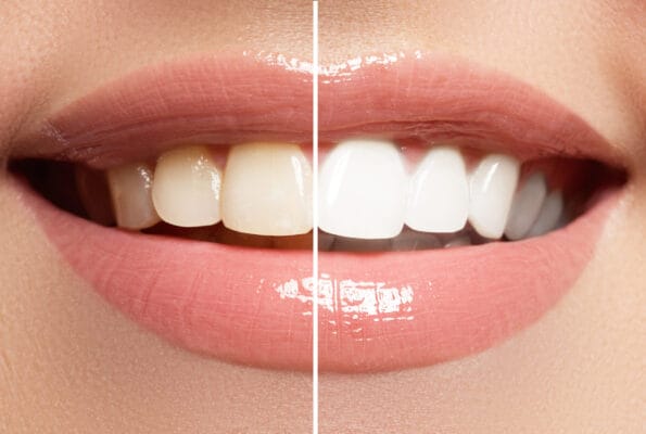 Full Mouth Veneers Cost in the Dominican Republic – What to Expect